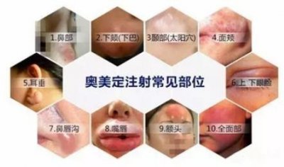 ​奥美定取出 奥美定取出为何这么难？必须手术取出吗？