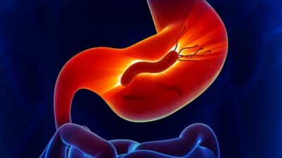 ​幽门螺旋杆菌阳性是什么病（幽门螺杆菌“阳性”，是不是很严重？需要治疗吗？