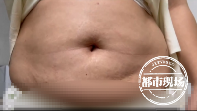 ​腹部吸脂减肥 女子花3万元抽脂多处凹凸不平 南昌高新医院：属正常现象