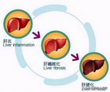 ​肝癌有哪些症状和预兆（肝癌前期不痛不痒？身体有这4个表现症状，预示肝脏有