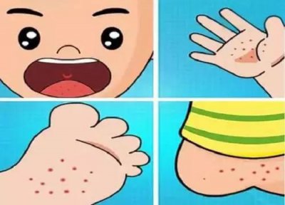 ​手足口病多久可以痊愈 得了手足口病怎么办？