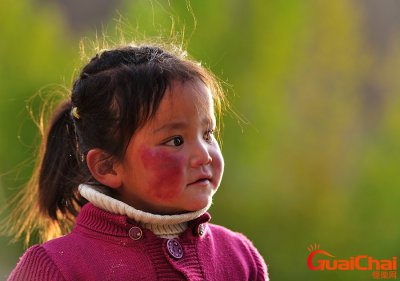 ​高原红脸蛋怎么去除？高原红怎么治疗和修复