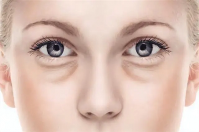 ​眼袋为什么会大  有眼袋怎么回事