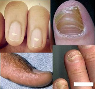 ​看看这些不健康的指甲有没有你的！