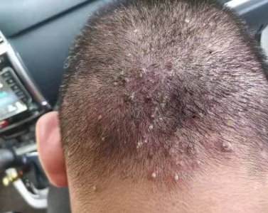 ​每年夏天头皮毛囊炎就发作 每年夏天头皮毛囊炎怎么办