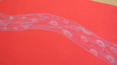 ​血脂高在腿上有什么表现症状 血脂高在腿上有什么表现图片