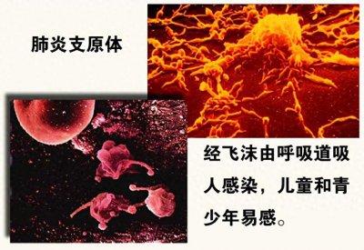 ​小儿肺炎支原体肺炎诊疗指南最新修订 儿童肺炎支原体肺炎诊疗指南