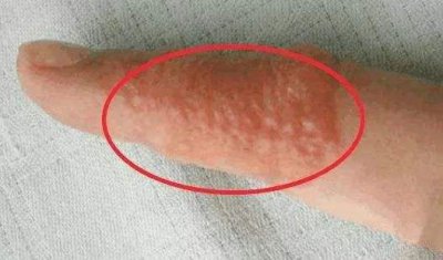 ​手上出现小水泡还发痒身体告诉你 手上有小水泡发痒