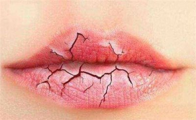 ​一到干燥天，嘴唇就干裂脱皮，总以为是缺水，却不知道是缺少它