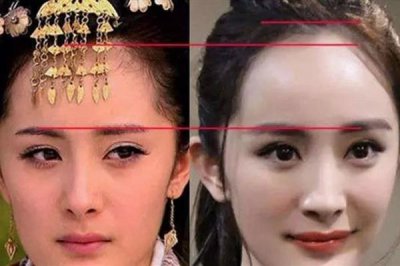 ​发际线可以自行恢复吗 发际线后移的原因