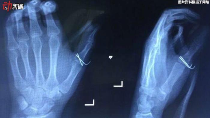 男生手指被炸骨折，都是一瓶冰可乐惹的祸！