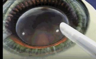 十年前悄咪咪做了近视激光手术的明星们,现在还好吗?