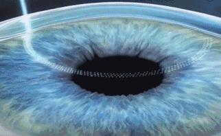 十年前悄咪咪做了近视激光手术的明星们,现在还好吗?