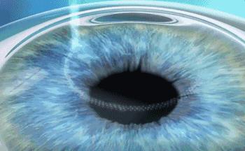 十年前悄咪咪做了近视激光手术的明星们,现在还好吗?