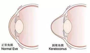 十年前悄咪咪做了近视激光手术的明星们,现在还好吗?
