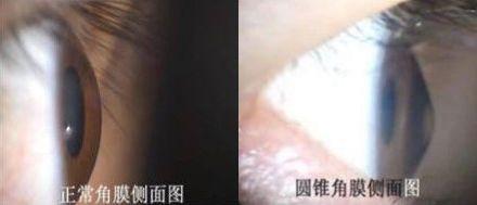 十年前悄咪咪做了近视激光手术的明星们,现在还好吗?