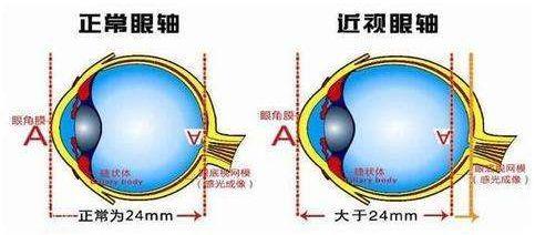 十年前悄咪咪做了近视激光手术的明星们,现在还好吗?